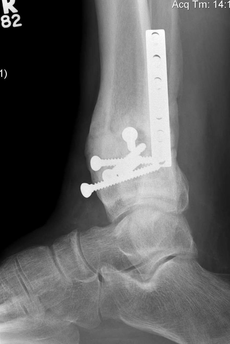 Distal Tibial Malunion Lateral